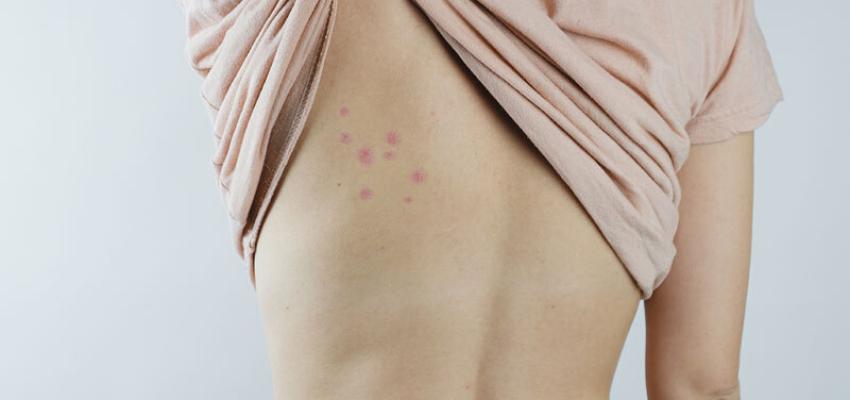 Bed Bug Bites on Back